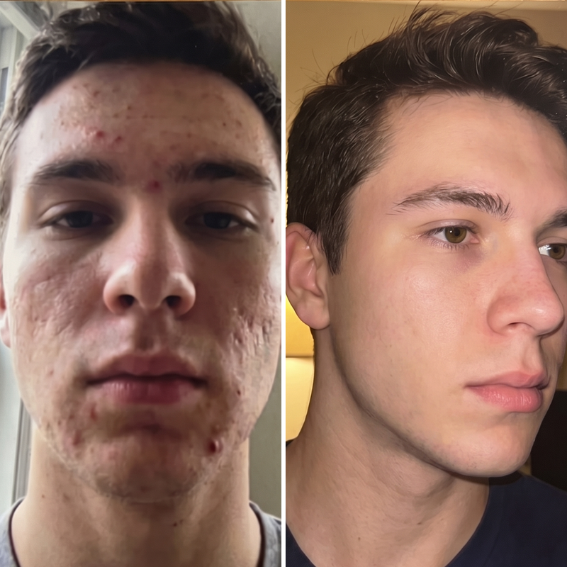 Cystic-prone skin