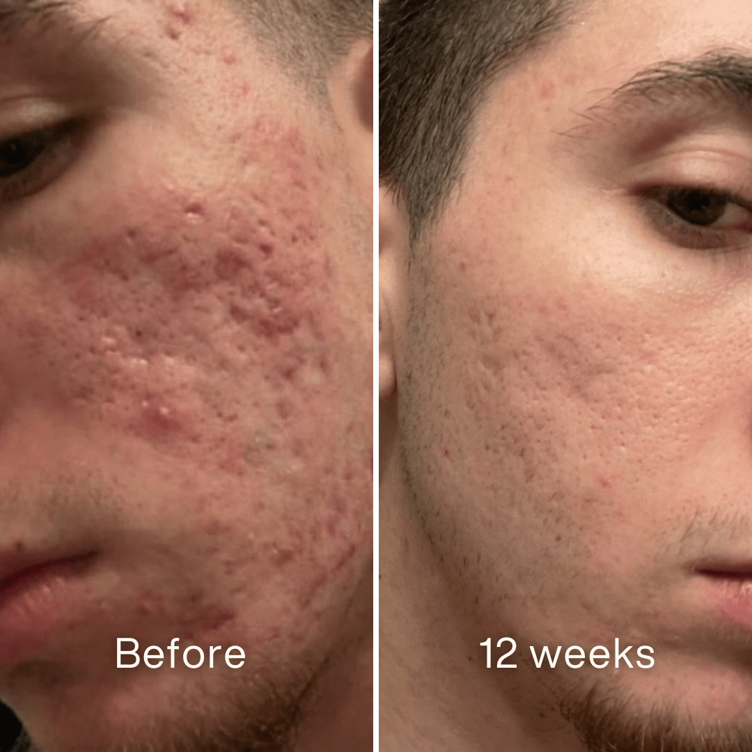Before and after: side of a man's face, inflamed acne and pitted marks on the cheek before, less redness at 12 weeks