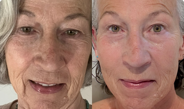 Side-by-side photos of a gray-haired woman's face, with deep lines on the left and smoother-looking skin on the right