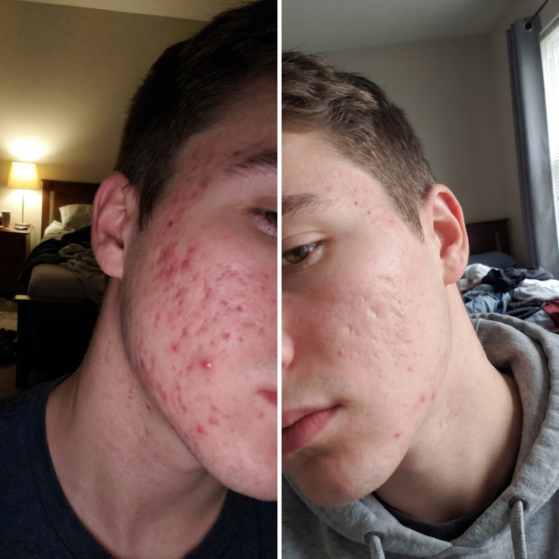 Teen skin