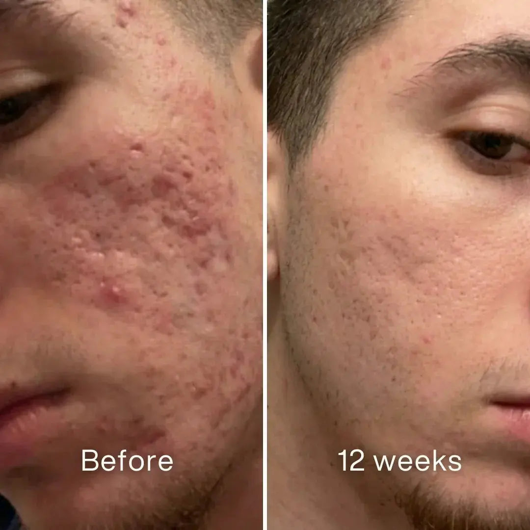 Before and after: man's cheek with red, raised acne scarring, flatter and less red at 12 weeks