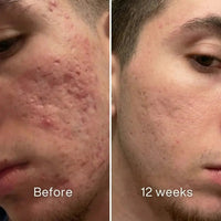 Before and after: man's cheek with red, raised acne scarring, flatter and less red at 12 weeks