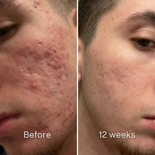 Before and after: man's cheek with red, raised acne scarring, flatter and less red at 12 weeks