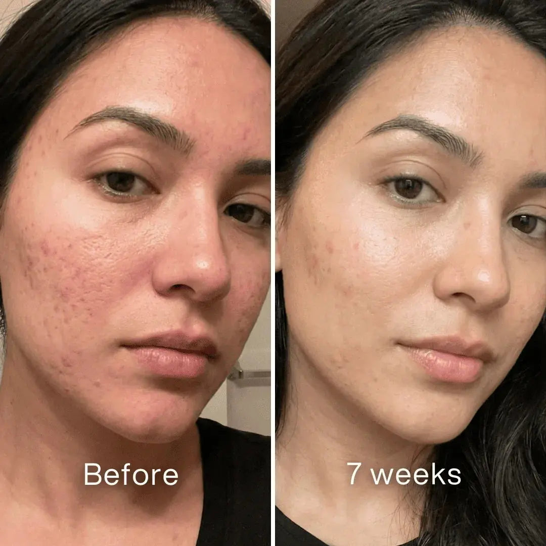 Before and after: woman's cheek with pitted acne scars and redness, smoother and less red at 7 weeks