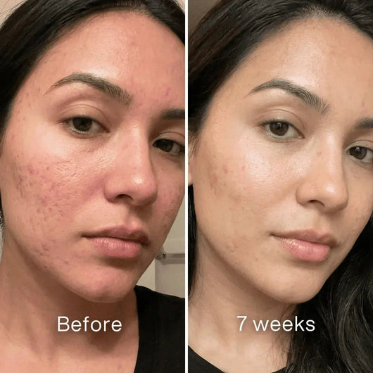 Before and after: woman's cheek with pitted acne scars and redness, smoother and less red at 7 weeks