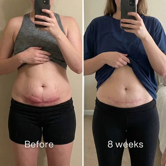 Before and after mirror selfies: pink c-section scar on the lower abdomen, lighter and flatter at 8 weeks