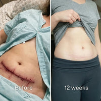 Before and after: red c-section incision across the lower abdomen, a thin pale pink line at 12 weeks