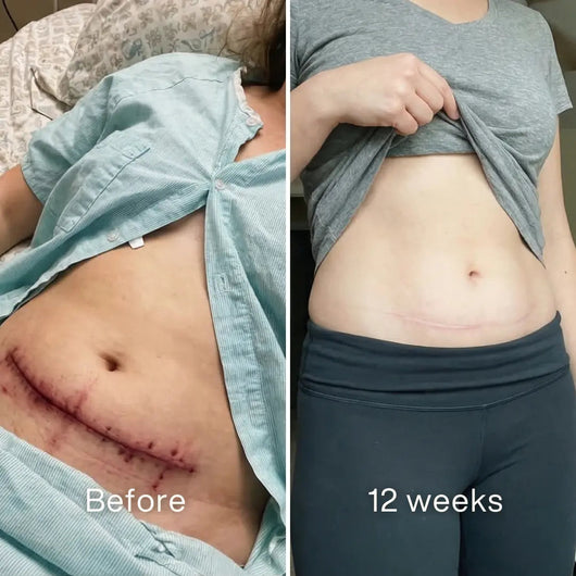 Before and after: red c-section incision across the lower abdomen, a thin pale pink line at 12 weeks