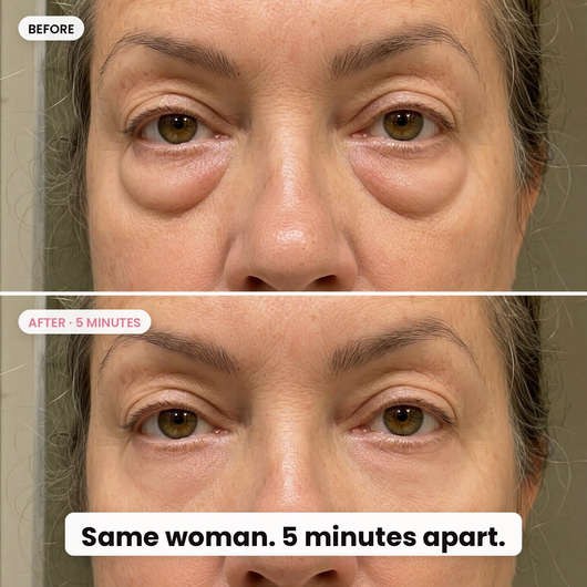 Same woman, 5 minutes apart: under-eye bags before and after