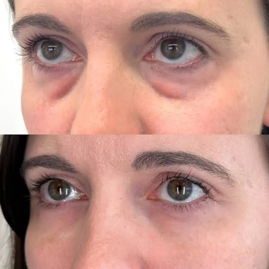 Instant Under-Eye Tightener™ - Pluune