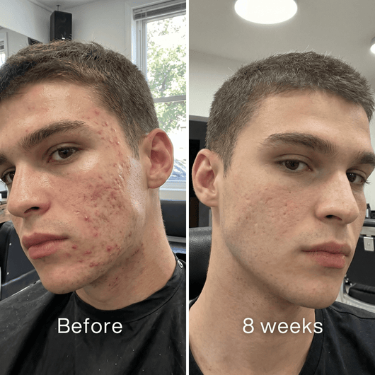 Before and after: man in a barber chair, red acne breakouts on his cheek before, fewer and less red at 8 weeks