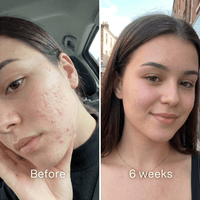 Before and after: woman's cheek with red acne breakouts before, fewer blemishes and less redness at 6 weeks