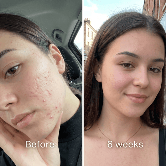 Before and after: woman's cheek with red acne breakouts before, fewer blemishes and less redness at 6 weeks