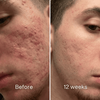 Before and after: side of a man's face, inflamed acne and pitted marks on the cheek before, less redness at 12 weeks
