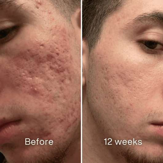 Before and after: side of a man's face, inflamed acne and pitted marks on the cheek before, less redness at 12 weeks