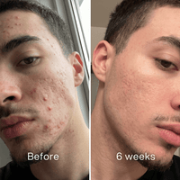Before and after: man's face with red acne spots on the cheek and forehead before, fewer spots at 6 weeks