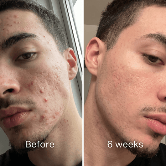 Before and after: man's face with red acne spots on the cheek and forehead before, fewer spots at 6 weeks