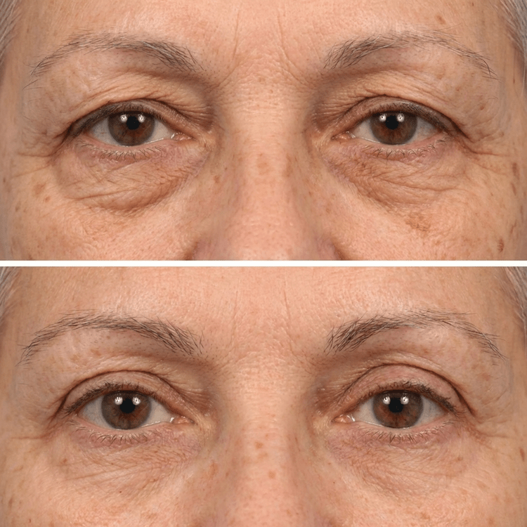 Reverse-Aging Temporary Eye Tightener: Younger Looking Eyes In 90 Seconds - Pluune