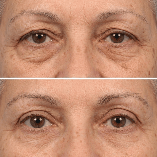 Reverse-Aging Temporary Eye Tightener: Younger Looking Eyes In 90 Seconds - Pluune