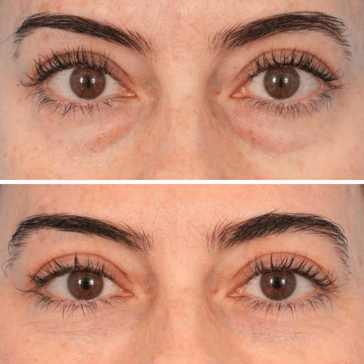 Reverse-Aging Temporary Eye Tightener: Younger Looking Eyes In 90 Seconds - Pluune