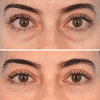 Reverse-Aging Temporary Eye Tightener: Younger Looking Eyes In 90 Seconds - Pluune