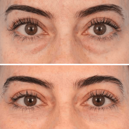Reverse-Aging Temporary Eye Tightener: Younger Looking Eyes In 90 Seconds - Pluune