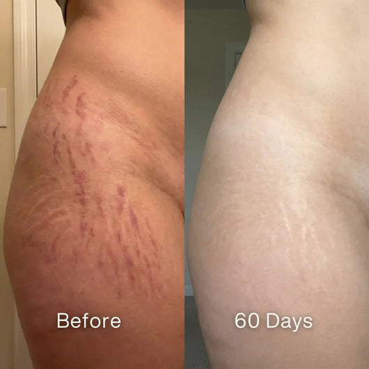 Before and after: red and purple stretch marks on a hip and thigh, lighter and less visible at 60 days