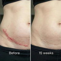 Before and after: long red scar across the lower abdomen, paler and flatter at 15 weeks