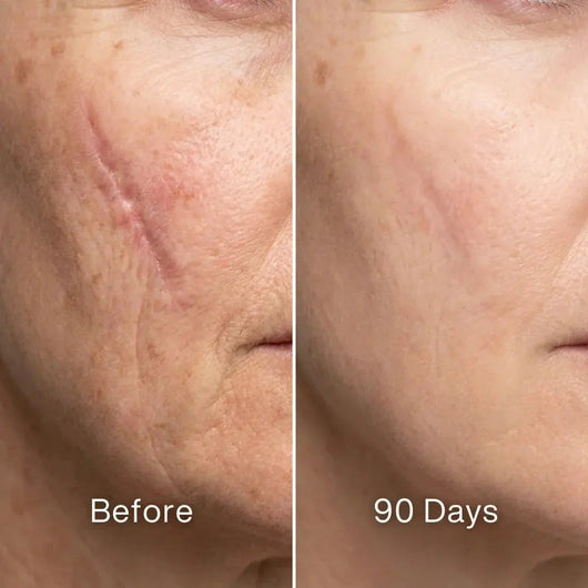 Before and after: raised pink scar on a cheek, flatter and closer to the skin tone at 90 days