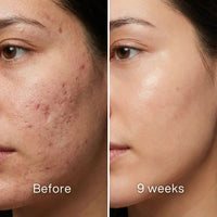Before and after: woman's cheek with red acne marks and pitted scars, more even and less red at 9 weeks