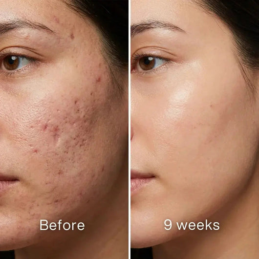 Before and after: woman's cheek with red acne marks and pitted scars, more even and less red at 9 weeks