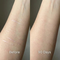 Before and after: thin pale parallel scars on a forearm, fainter at 90 days