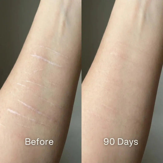 Before and after: thin pale parallel scars on a forearm, fainter at 90 days