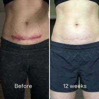 Before and after: red horizontal scar across the lower abdomen, lighter and flatter at 12 weeks