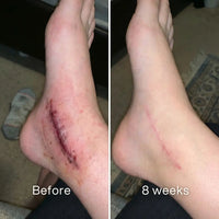 Before and after: red stitched surgical incision on an ankle, a thin pink line at 8 weeks