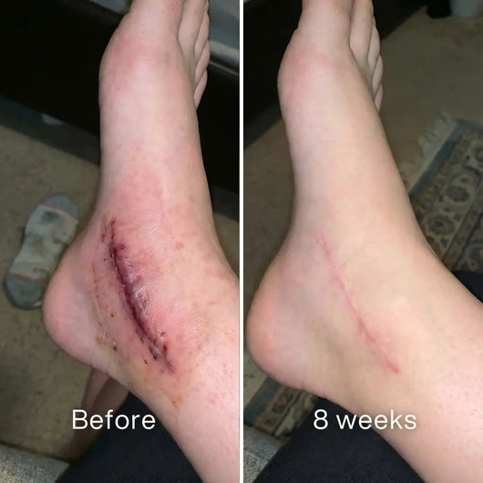 Before and after: red stitched surgical incision on an ankle, a thin pink line at 8 weeks