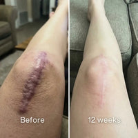 Before and after: thick purple raised scar on a knee, flatter and pale pink at 12 weeks