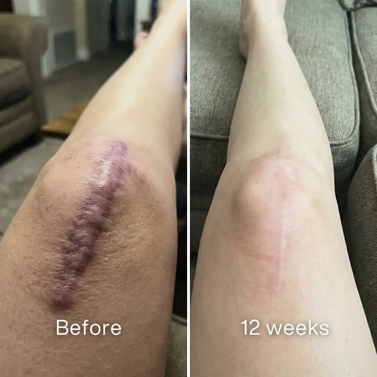 Before and after: thick purple raised scar on a knee, flatter and pale pink at 12 weeks